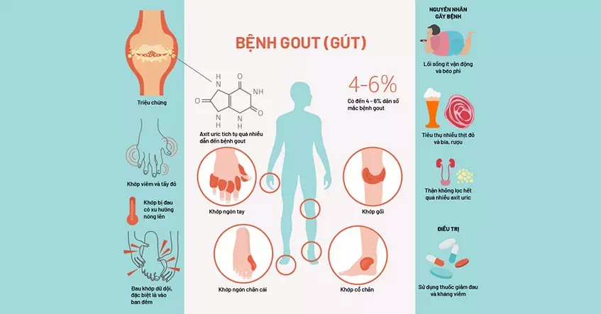 Bệnh Gut (Gout)