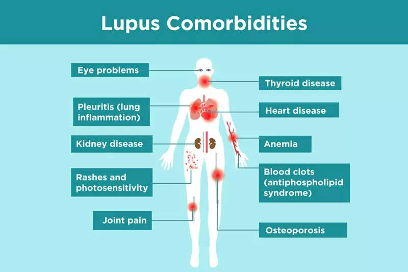 Biến chứng của bệnh lupus ban đỏ hệ thống