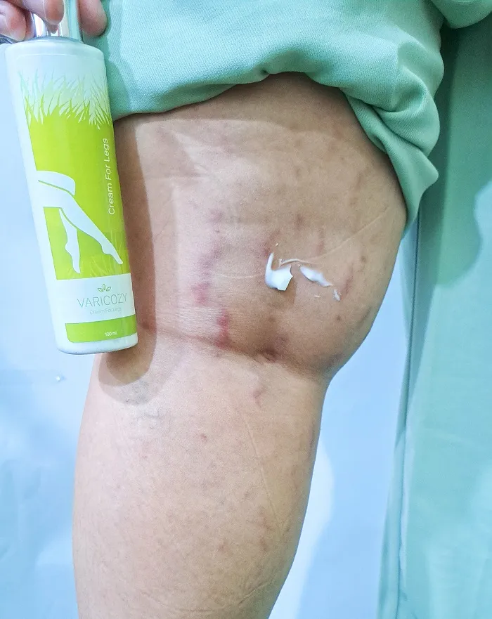 Varicozy Cream: Atasi Varises Tanpa Operasi dengan Cepat & Alami